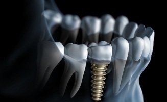 Animated x ray of a person with a dental implant