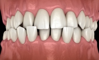 Animated teeth with crossbite