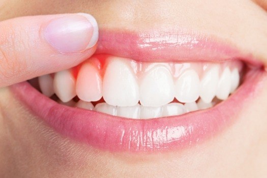 Close up of person pointing to red spot in their gums