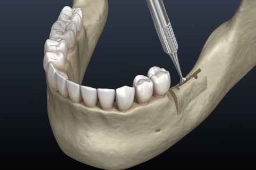 Animated dental instrument operating on jaw ridge bone