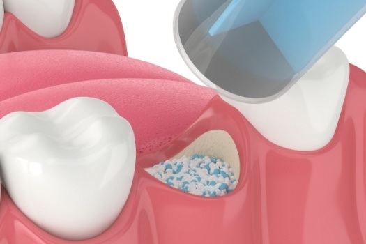 Animated dental bone grafting material being placed in jawbone where tooth is missing