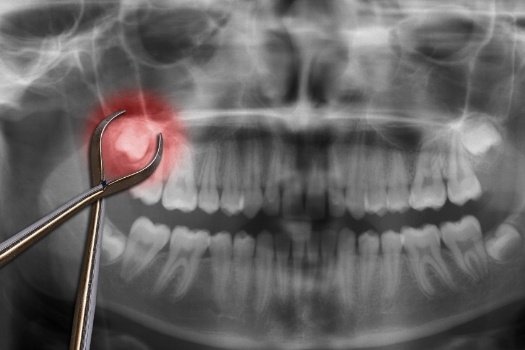 Dental x rays with wisdom teeth highlighted red