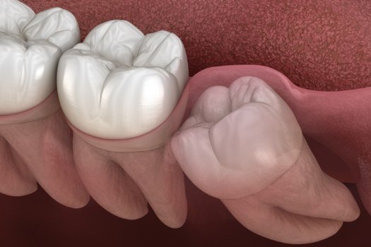 Close up of animated impacted wisdom tooth