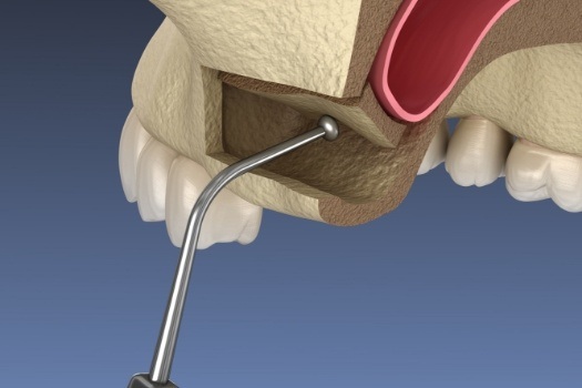 Animated sinus lift procedure