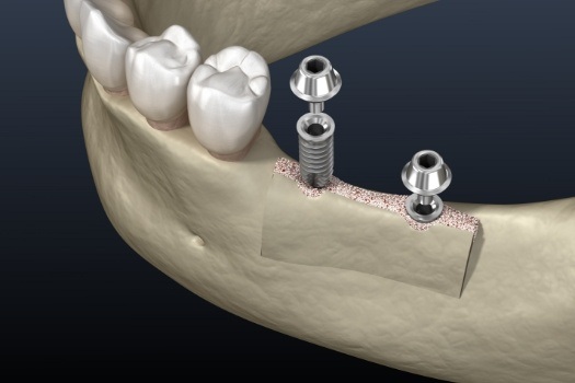 Two animated dental implants being placed in lower jawbone