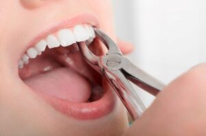 Forceps held to someone's teeth for an extraction